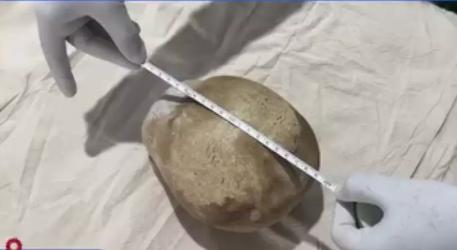 پزشکان سریلانکا سنگ ۳.۱ کیلویی را از مثانه یک مرد خارج کردند
