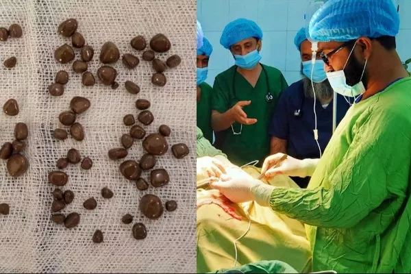 پزشکان در ننگرهار ۸۵ سنگ را از گرده یک بیمار کشیدند