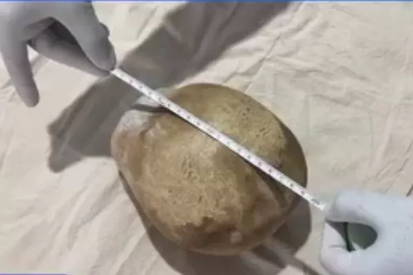 پزشکان سریلانکا سنگ ۳.۱ کیلویی را از مثانه یک مرد خارج کردند