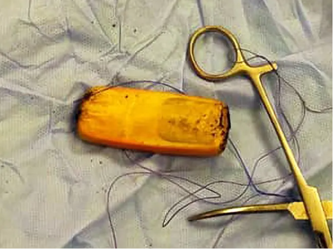 یک زندانی در مصر تلفن را بلعید و شش سال در معده‌اش ماند