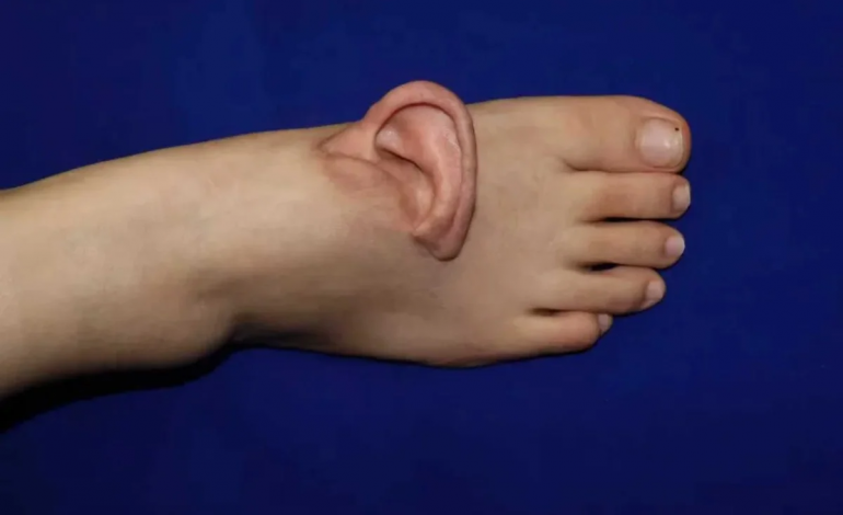 پزشکان در چین گوش یک زن را به پایش پیوند زدند